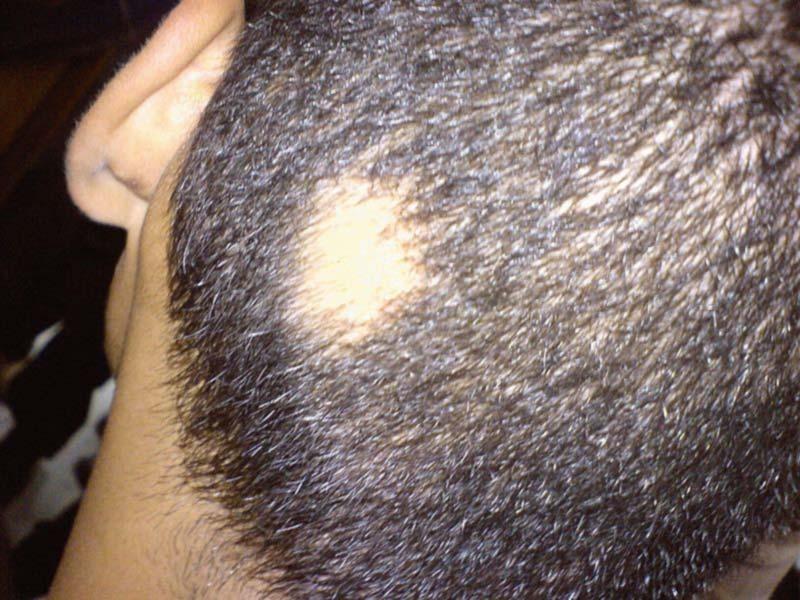 Alopecia areata en la nuca