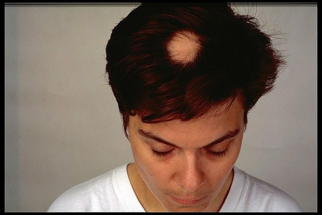 Alopecia areata en la cabeza de una mujer
