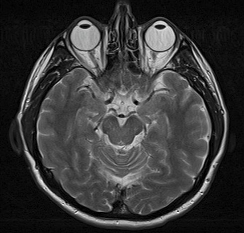 Resonancia magnética