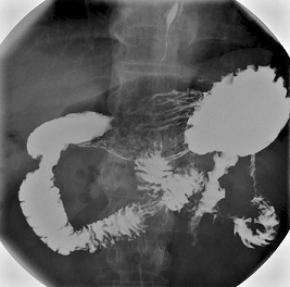 Comida de bario estómago