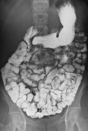 Seguimiento del bario