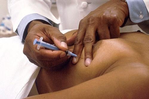 Aspiración con aguja fina