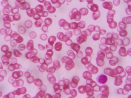 Anemia falciforme