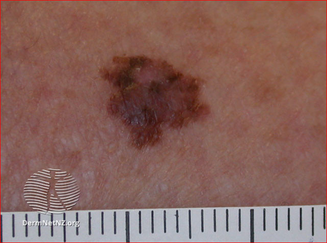 Melanoma de extensión superficial
