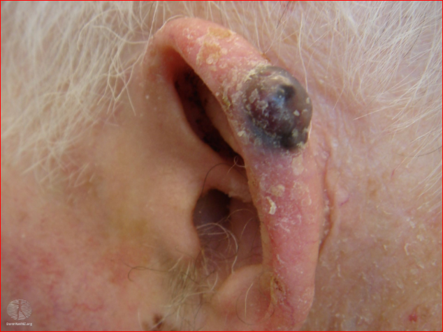 Melanoma nodular en una oreja