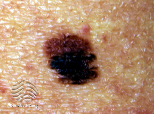 Nevus atípico