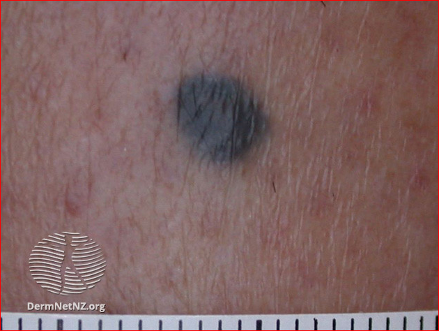 Nevus azul