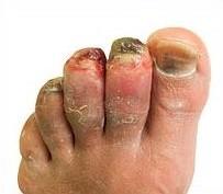 Congelación - lesión inicial