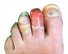 Congelación 12 días después de la lesión