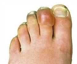 Lesión por congelación después de tres semanas