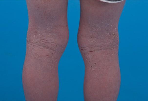 Eczema atópico