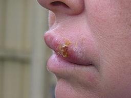 Herpes labial