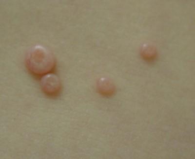 Molusco contagioso