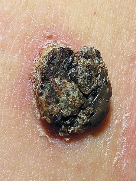 Queratosis seborreica