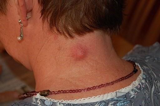 Quiste epidermoide en el cuello