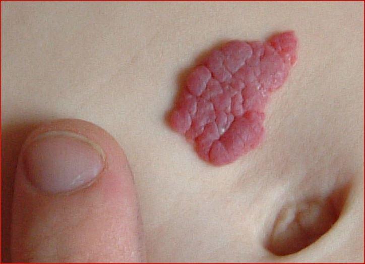 Hemangioma - névus fresa