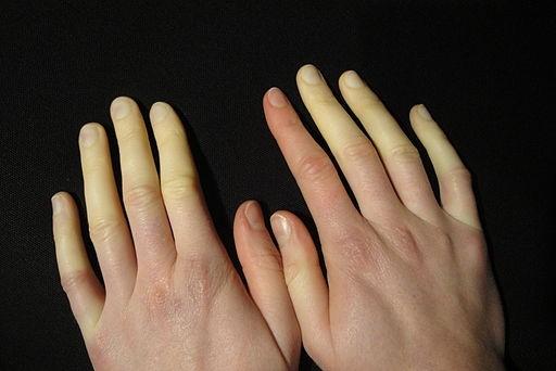 Enfermedad de Raynaud