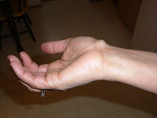 quiste ganglionar muñeca
