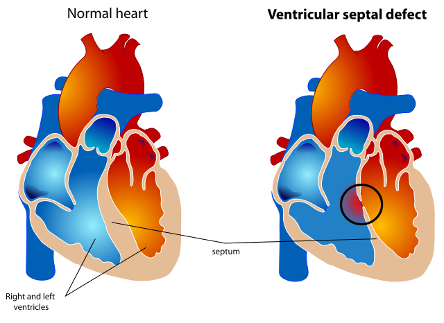 Comunicación interventricular