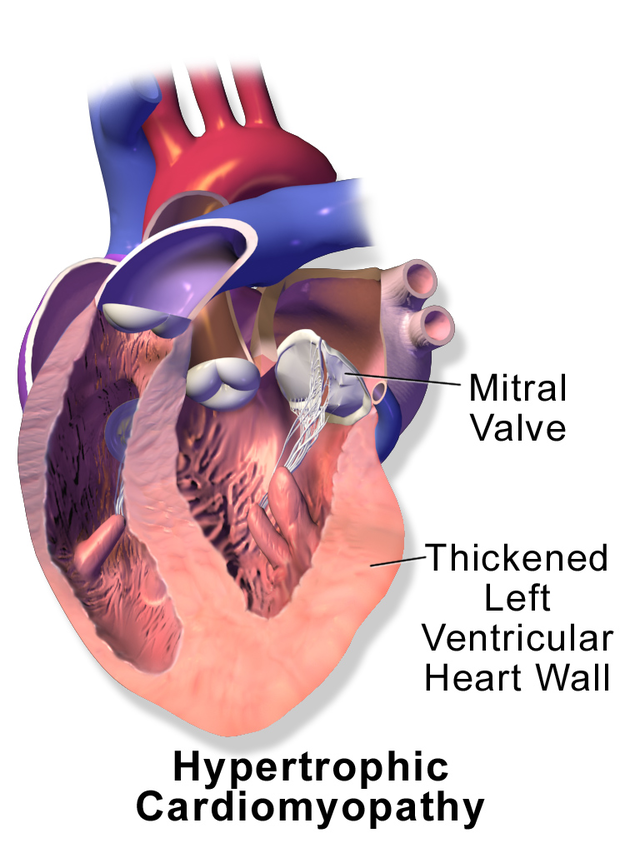 Miocardiopatía hipertrófica
