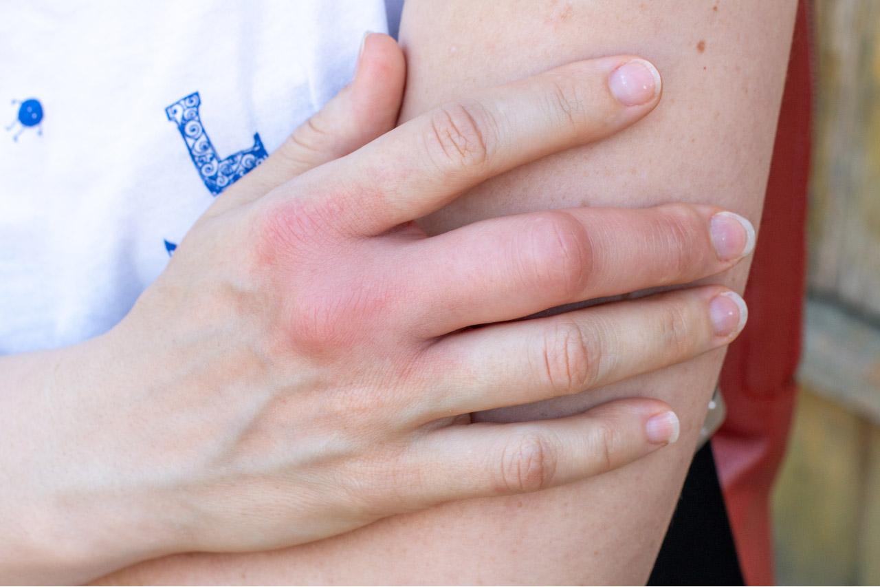 Foto de una picadura de avispa en una mano