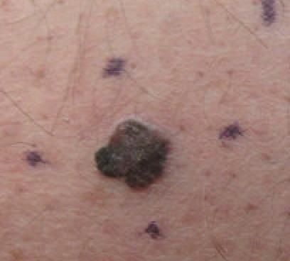 Melanoma maligno