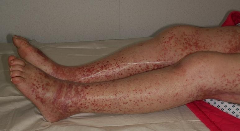 Púrpura de Henoch-Schönlein