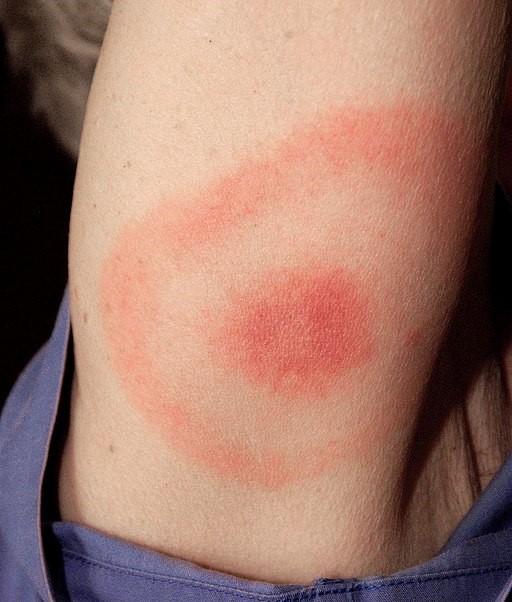 Erupción de la enfermedad de Lyme