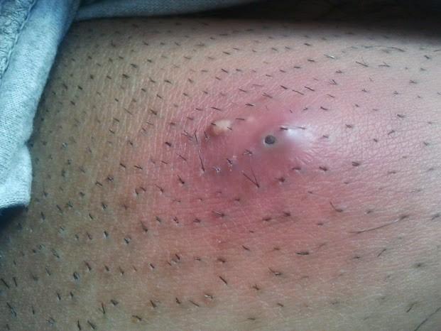 Absceso de cinco días