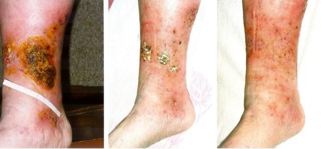 Eczema varicoso