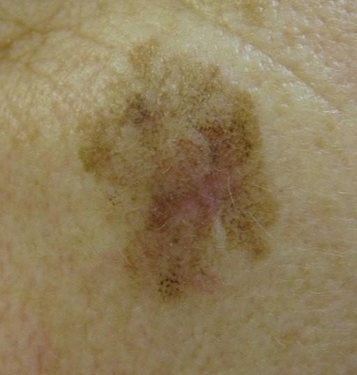Lentigo maligno