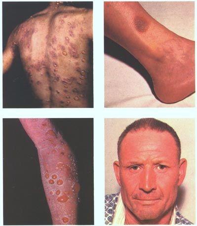 Erupciones medicamentosas