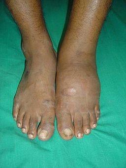 Charcot presentation