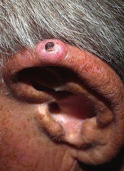 Condrodermatitis nodular