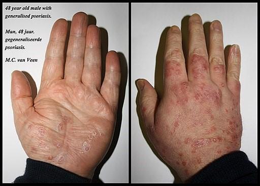 Psoriasis manos