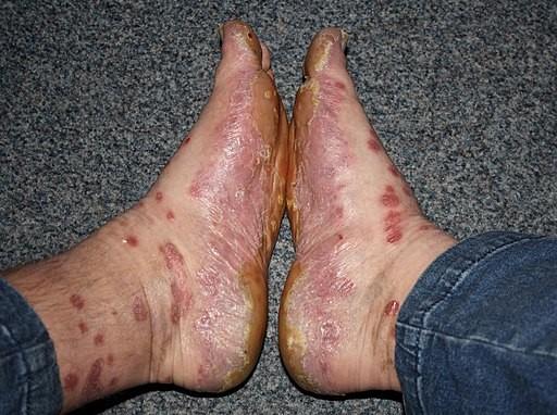 Psoriasis pies