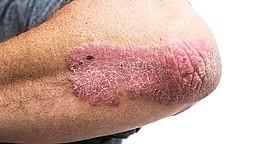 Psoriasis en placas