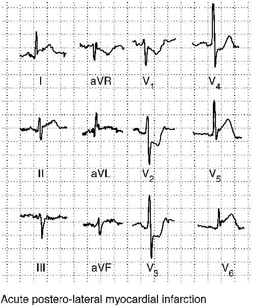 INFARTO DE MIOCARDIO