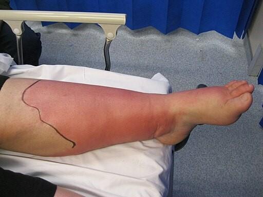 Celulitis en la pierna (Wikimedia Commons)