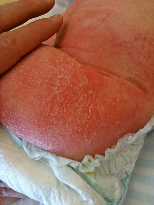 Dermatitis atópica infantil