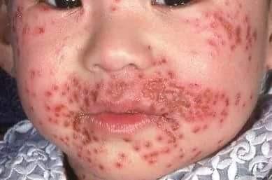 Eczema herpético