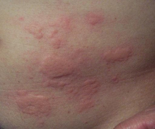Una imagen de urticaria en la piel de una persona